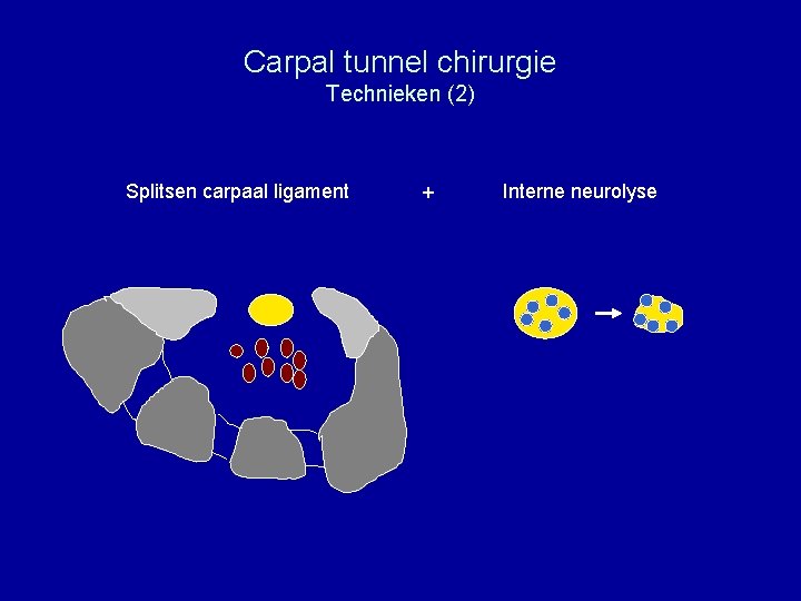 Carpal tunnel chirurgie Technieken (2) Splitsen carpaal ligament + Interne neurolyse 