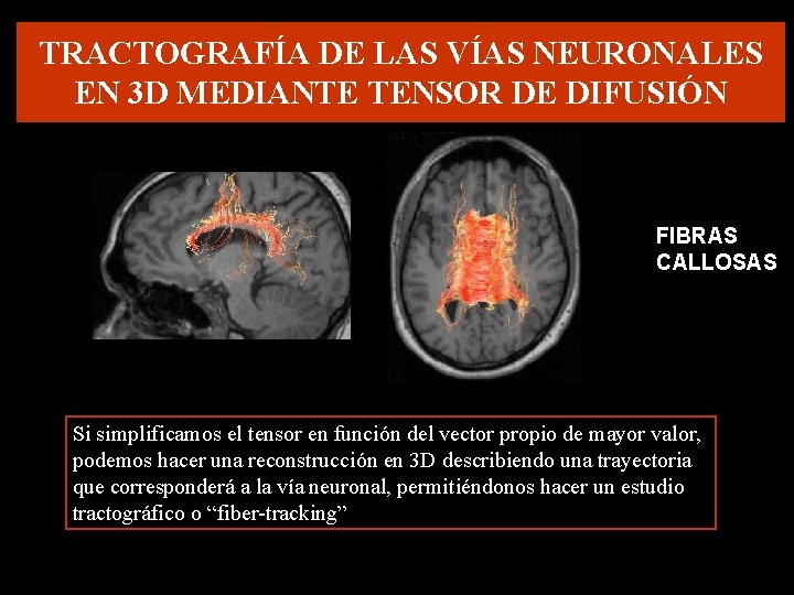 TRACTOGRAFÍA DE LAS VÍAS NEURONALES EN 3 D MEDIANTE TENSOR DE DIFUSIÓN FIBRAS CALLOSAS