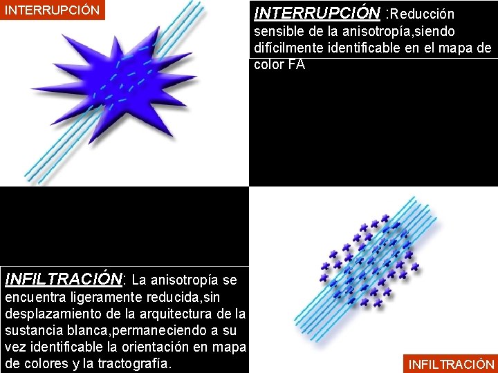 INTERRUPCIÓN : Reducción sensible de la anisotropía, siendo difícilmente identificable en el mapa de