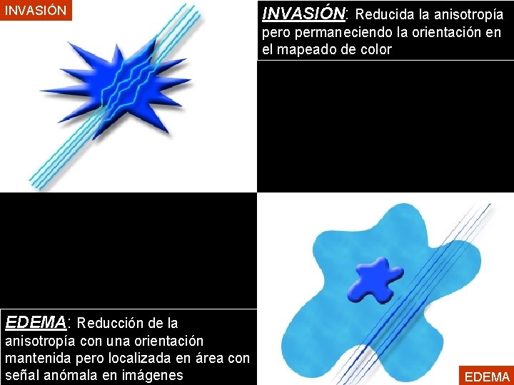 INVASIÓN: Reducida la anisotropía pero permaneciendo la orientación en el mapeado de color EDEMA: