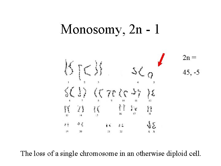 Monosomy, 2 n - 1 2 n = 45, 46 -5 The loss of