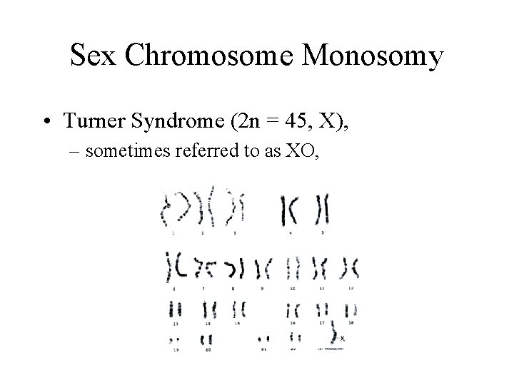 Sex Chromosome Monosomy • Turner Syndrome (2 n = 45, X), – sometimes referred