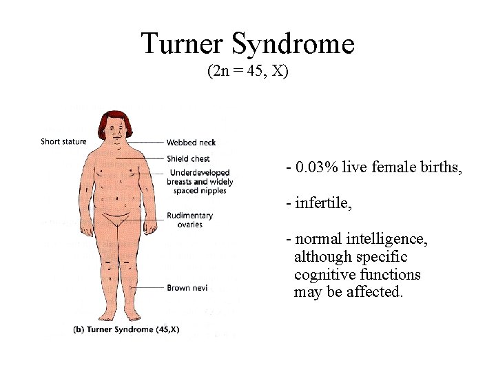 Turner Syndrome (2 n = 45, X) - 0. 03% live female births, -