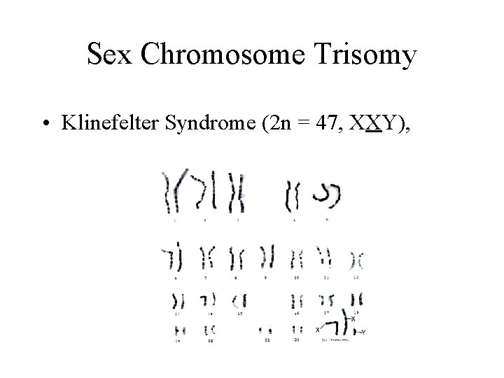 Sex Chromosome Trisomy • Klinefelter Syndrome (2 n = 47, XXY), 