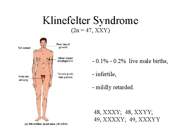 Klinefelter Syndrome (2 n = 47, XXY) - 0. 1% - 0. 2% live