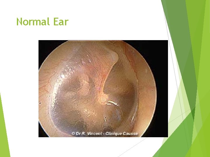 Normal Ear 