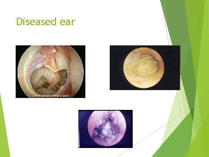 Diseased ear 