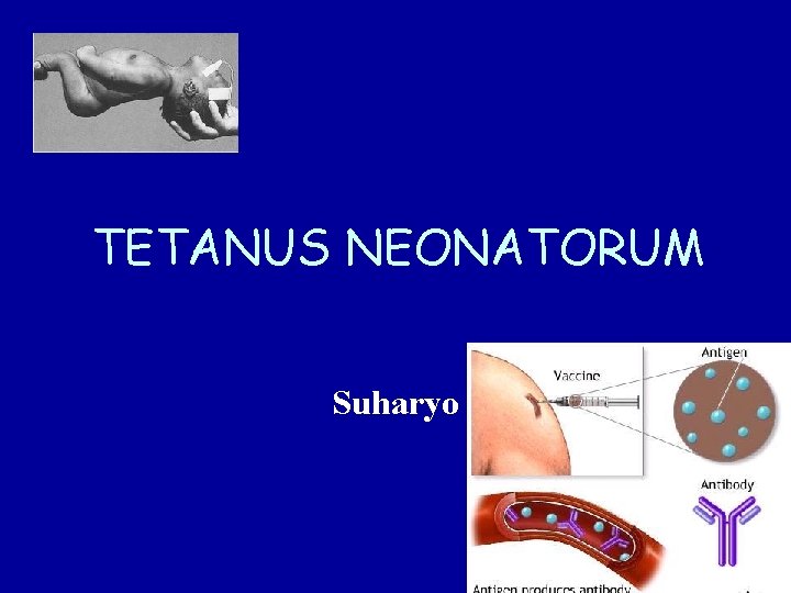 TETANUS NEONATORUM Suharyo 