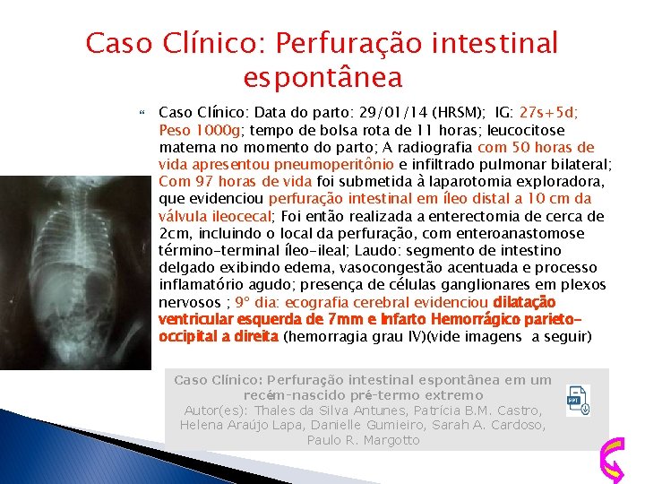 Caso Clínico: Perfuração intestinal espontânea Caso Clínico: Data do parto: 29/01/14 (HRSM); IG: 27