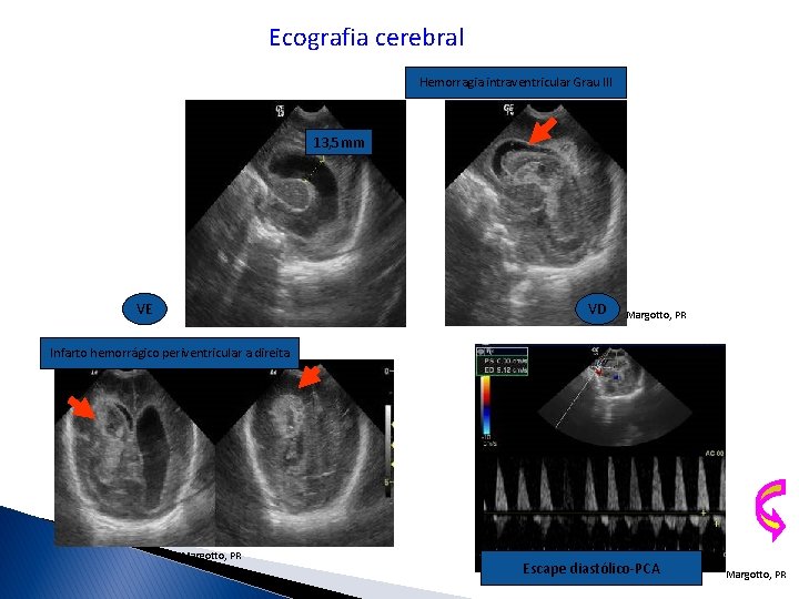 Ecografia cerebral Hemorragia intraventricular Grau III 13, 5 mm VE VD Margotto, PR Infarto