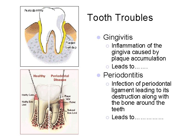 Tooth Troubles l Gingivitis ¡ ¡ l Inflammation of the gingiva caused by plaque