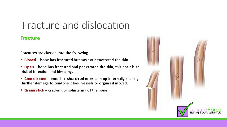 Fracture and dislocation Fractures are classed into the following: § Closed – bone has