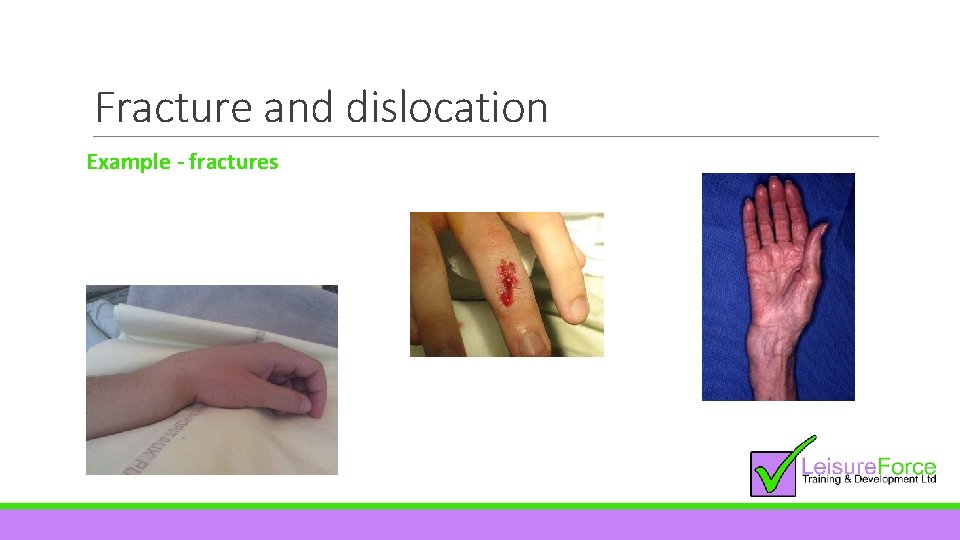 Fracture and dislocation Example - fractures 