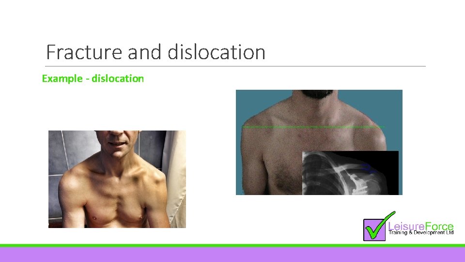 Fracture and dislocation Example - dislocation 