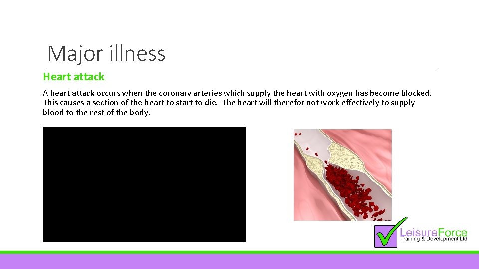 Major illness Heart attack A heart attack occurs when the coronary arteries which supply