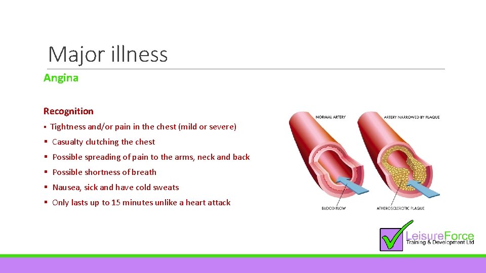 Major illness Angina Recognition § Tightness and/or pain in the chest (mild or severe)