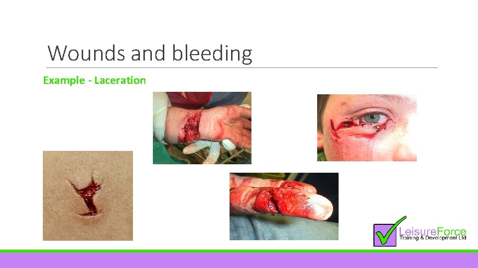 Wounds and bleeding Example - Laceration 