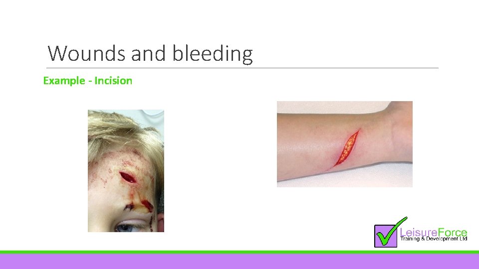 Wounds and bleeding Example - Incision 