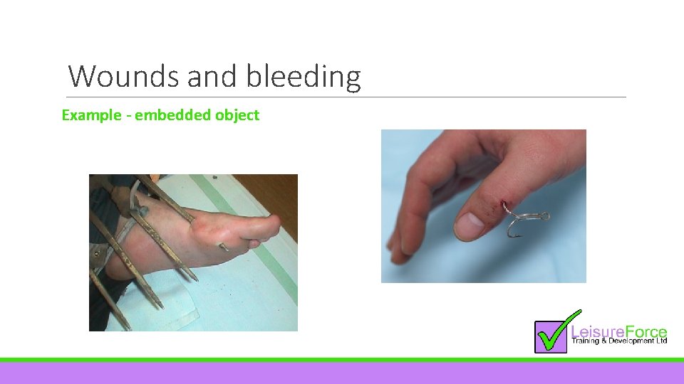 Wounds and bleeding Example - embedded object 