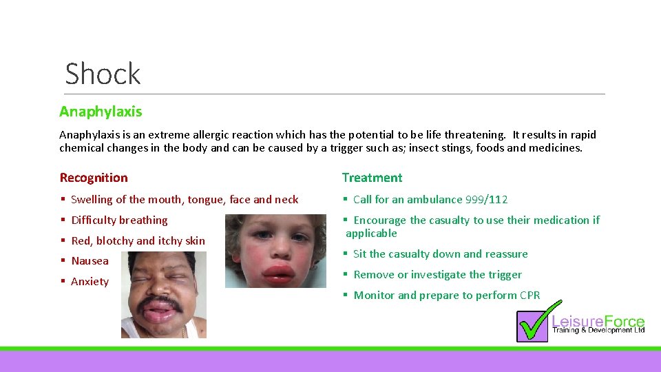 Shock Anaphylaxis is an extreme allergic reaction which has the potential to be life