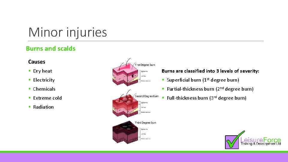 Minor injuries Burns and scalds Causes § Dry heat Burns are classified into 3