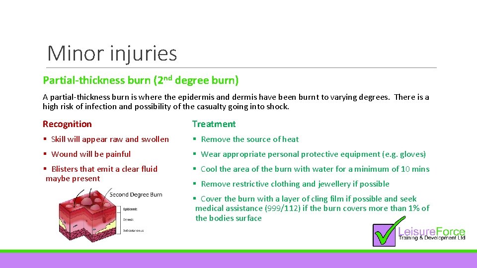 Minor injuries Partial-thickness burn (2 nd degree burn) A partial-thickness burn is where the
