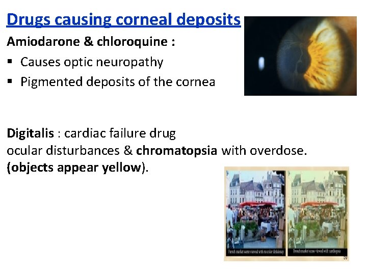 Drugs causing corneal deposits Amiodarone & chloroquine : § Causes optic neuropathy § Pigmented