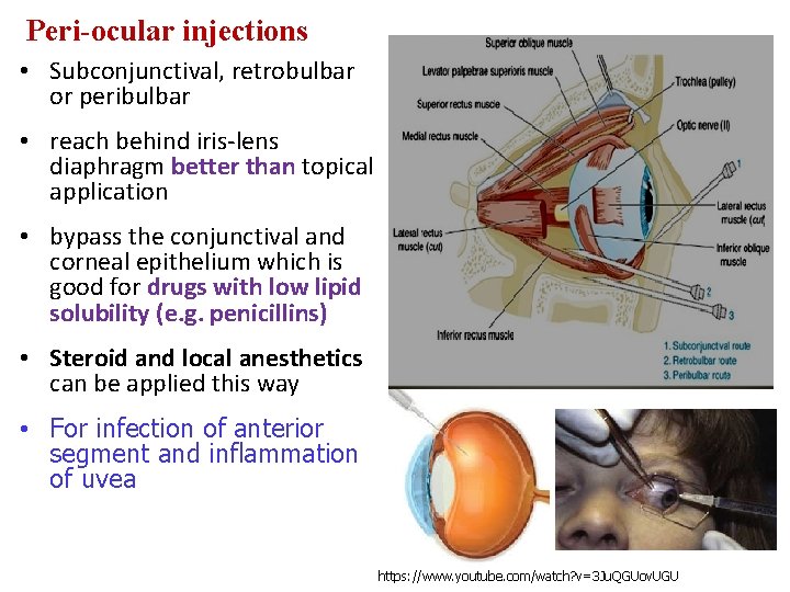 Peri-ocular injections • Subconjunctival, retrobulbar or peribulbar • reach behind iris-lens diaphragm better than Peri-ocular injections • Subconjunctival, retrobulbar or peribulbar • reach behind iris-lens diaphragm better than