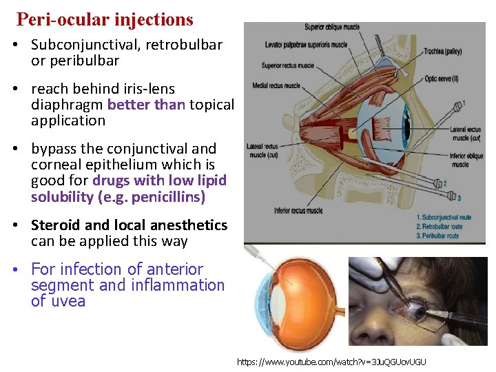 Peri-ocular injections • Subconjunctival, retrobulbar or peribulbar • reach behind iris-lens diaphragm better than