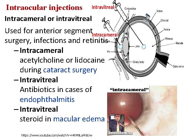 Intraocular injections Intracameral or intravitreal Used for anterior segment surgery, infections and retinitis –