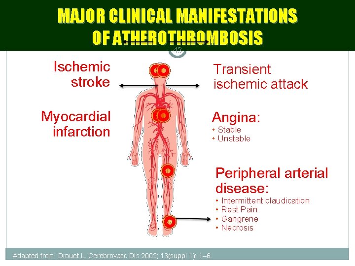 MAJOR CLINICAL MANIFESTATIONS OF ATHEROTHROMBOSIS 43 Ischemic stroke Myocardial infarction Transient ischemic attack Angina: