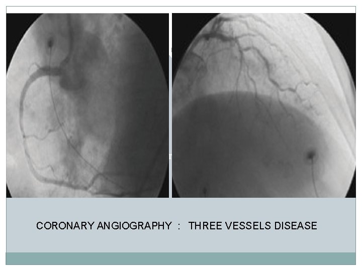 71 -year-old female Cardiovascular risk factors Hypertension diagnosed more than 15 years before. CORONARY