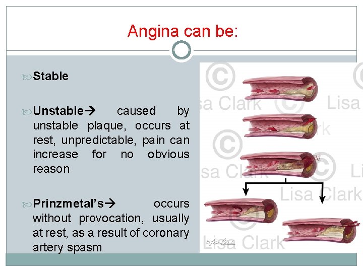 Angina can be: Stable Unstable caused by unstable plaque, occurs at rest, unpredictable, pain