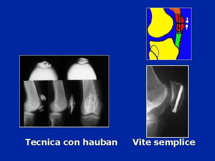 Tecnica con hauban Vite semplice 