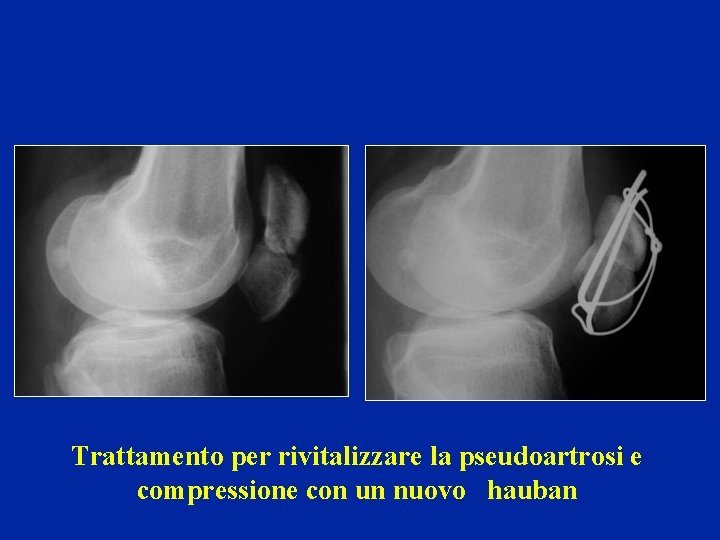 Trattamento per rivitalizzare la pseudoartrosi e compressione con un nuovo hauban 