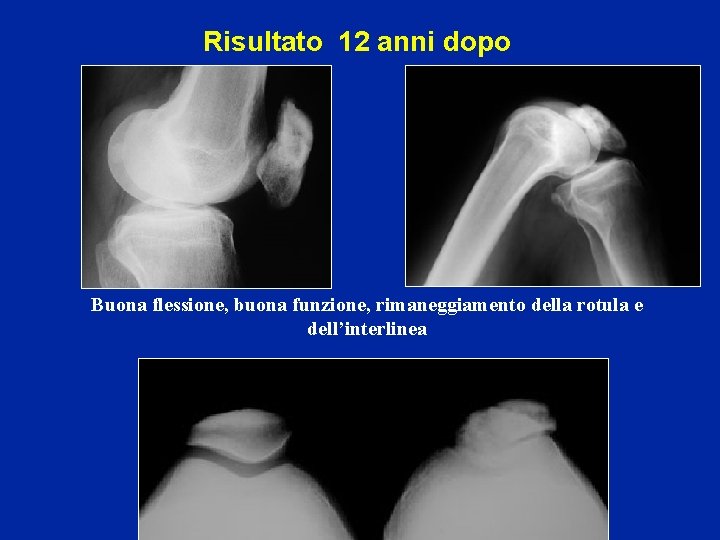 Risultato 12 anni dopo Buona flessione, buona funzione, rimaneggiamento della rotula e dell’interlinea 