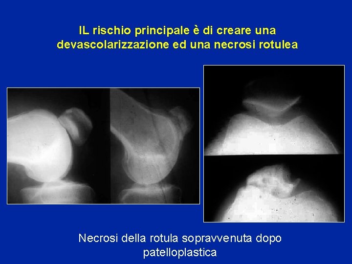 IL rischio principale è di creare una devascolarizzazione ed una necrosi rotulea Necrosi della