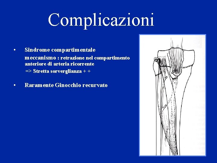 Complicazioni • Sindrome compartimentale meccanismo : retrazione nel compartimento anteriore di arteria ricorrente =>