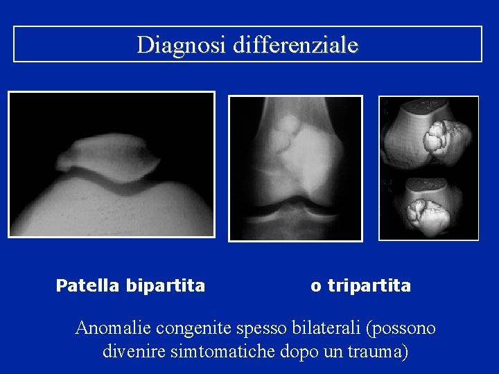 Diagnosi differenziale Patella bipartita o tripartita Anomalie congenite spesso bilaterali (possono divenire simtomatiche dopo