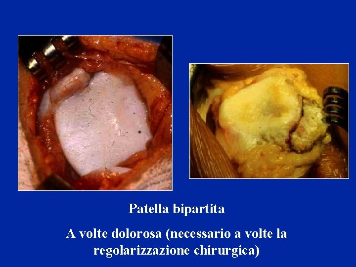 Patella bipartita A volte dolorosa (necessario a volte la regolarizzazione chirurgica) 