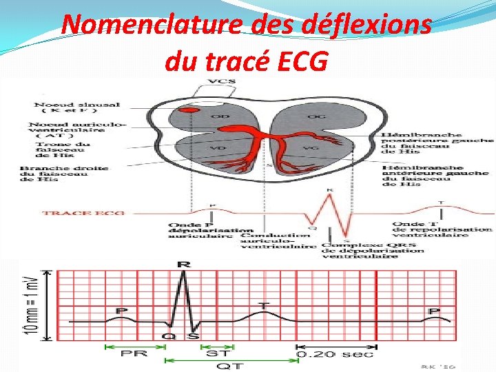 Nomenclature des déflexions du tracé ECG 