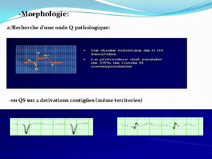 -Morphologie: a/Recherche d’une onde Q pathologique: -ou QS sur 2 derivations contigües (même territories)