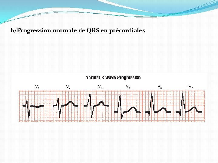 b/Progression normale de QRS en précordiales 