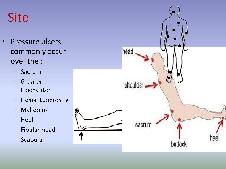 Site • Pressure ulcers commonly occur over the : – Sacrum – Greater trochanter