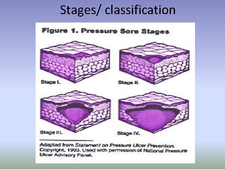 Stages/ classification 