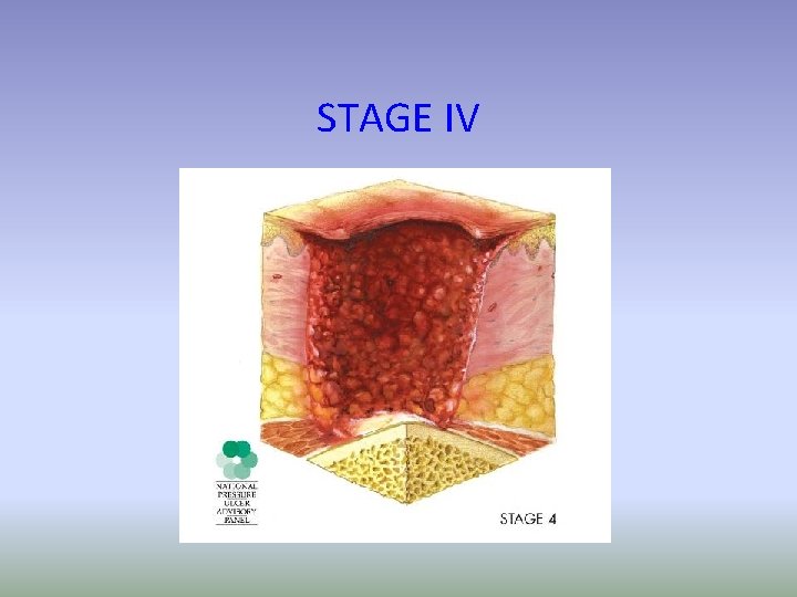 STAGE IV 