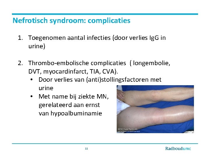 Nefrotisch syndroom: complicaties 1. Toegenomen aantal infecties (door verlies Ig. G in urine) 2.