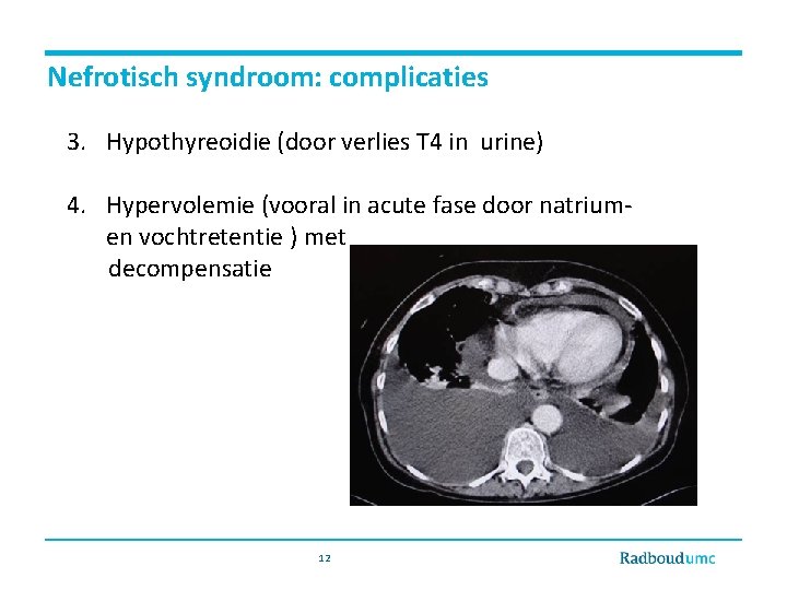 Nefrotisch syndroom: complicaties 3. Hypothyreoidie (door verlies T 4 in urine) 4. Hypervolemie (vooral