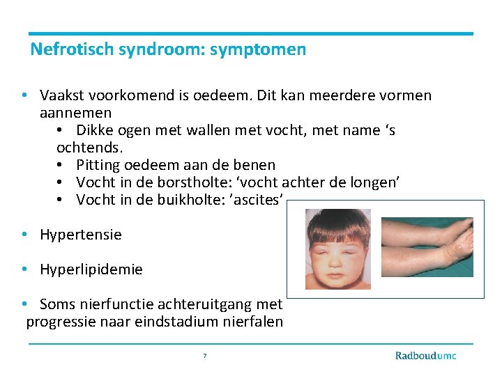 Nefrotisch syndroom: symptomen • Vaakst voorkomend is oedeem. Dit kan meerdere vormen aannemen •