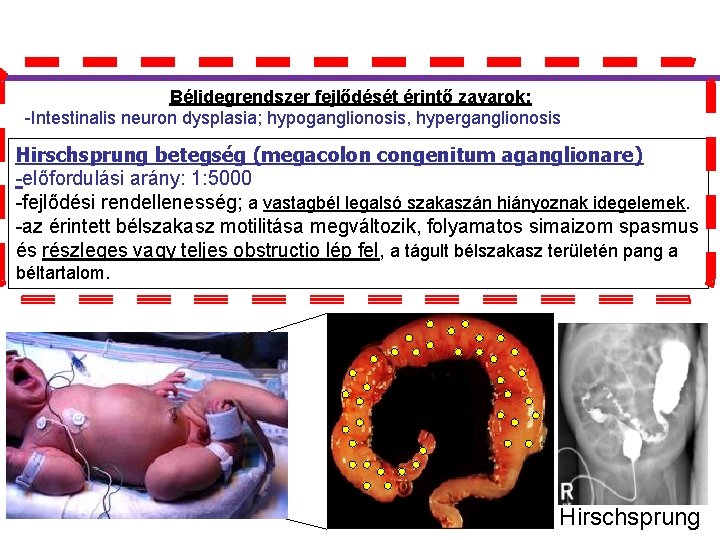 Bélidegrendszer fejlődését érintő zavarok: -Intestinalis neuron dysplasia; hypoganglionosis, hyperganglionosis Hirschsprung betegség (megacolon congenitum aganglionare)